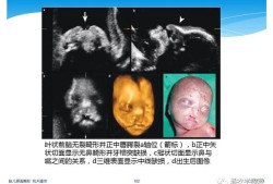 胎儿鼻子畸形图片（胎儿鼻子畸形图片大全）