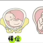 胎儿呈屈曲团抱位图片（胎儿呈屈曲团抱位姿势图）