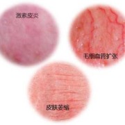 孕期用了激素药膏（皮肤病用激素药的后果是什么）