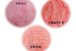 孕期用了激素药膏（皮肤病用激素药的后果是什么）