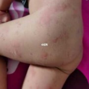 孕期荨麻疹会影响胎儿（孕期荨麻疹会影响胎儿吗）
