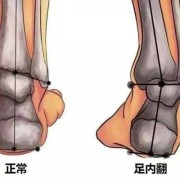 胎儿双足内翻怎么办（胎儿足内翻是脑瘫吗）