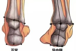 胎儿双足内翻怎么办（胎儿足内翻是脑瘫吗）