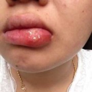 有孕期长了口唇疱疹的吗,孕期嘴角烂是什么原因造成的