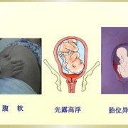 浮胎是什么意思,胎儿顶先露是啥意思