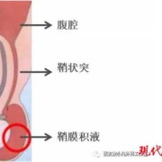 宝宝的两个蛋蛋竟然不一样大怎么办呢,胎儿睾丸有积液是怎么回事
