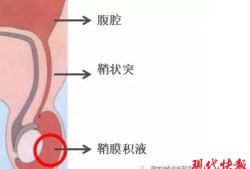 宝宝的两个蛋蛋竟然不一样大怎么办呢,胎儿睾丸有积液是怎么回事
