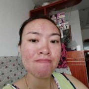 怀孕期间长痘痘怎么治（怀孕期间长痘痘怎么治疗）