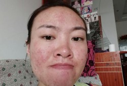 怀孕期间长痘痘怎么治（怀孕期间长痘痘怎么治疗）