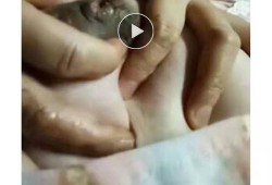 孕期胸部肿块（哺乳期，乳房里有肿块，怎么办）