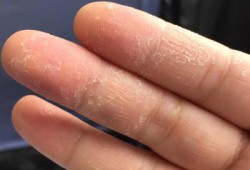 孕期手脱皮（孕期手脱皮是什么原因导致的）