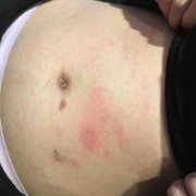 孕期肚子红点（孕期肚子长红点怎么回事）