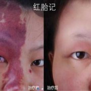 婴儿胎记怎么去除,怀孕胎儿胎记怎么引起的