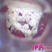 孕妇白带太多怎么办,孕晚期用手抠出一大坨豆腐渣