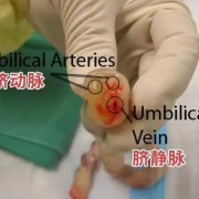胎儿脐动脉两条是什么意思,胎儿肚脐多久脱落