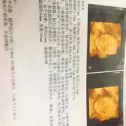 胎儿腿短结果是畸形（胎儿腿短结果是畸形怎么办）