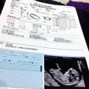 孕期nt（nt建档什么意思）
