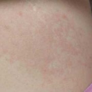 孕期腹部痒（孕期腹部痒怎么回事）