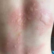 荨麻疹影响胎儿吗（荨麻疹影响胎儿吗）