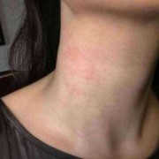 孕期脖子过敏（孕期脖子过敏非常痒怎么办）