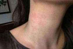 孕期脖子过敏（孕期脖子过敏非常痒怎么办）