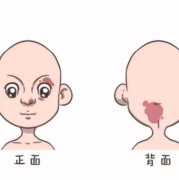 胎儿脸上胎记怎么预防（胎儿脸上胎记怎么预防遗传）