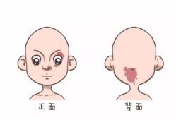 胎儿脸上胎记怎么预防（胎儿脸上胎记怎么预防遗传）