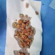 有身孕得肾结石怎么办,肾结石孕期还能补钙吗
