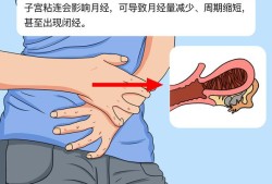 粘连带对胎儿有影响吗（子宫粘连带对胎儿有影响吗）