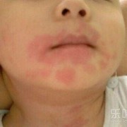 胎儿会过敏吗（宝宝食物过敏多久会出现症状？该怎么防治呢）