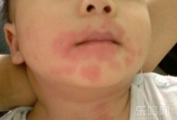 胎儿会过敏吗（宝宝食物过敏多久会出现症状？该怎么防治呢）