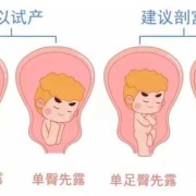 胎位不正是胎儿畸形吗（胎位不正是胎儿畸形吗）