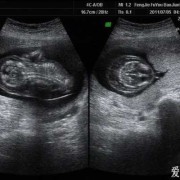 怀孕12周nt12胎儿颈部水囊瘤水肿怎么办,胎儿为什么会水肿和水囊瘤