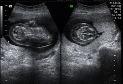 怀孕12周nt12胎儿颈部水囊瘤水肿怎么办,胎儿为什么会水肿和水囊瘤