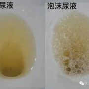 孕妇尿黄有泡沫是怎么回事,孕期尿液有泡沫是怎么回事