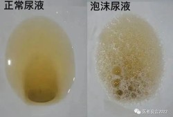 孕妇尿黄有泡沫是怎么回事,孕期尿液有泡沫是怎么回事