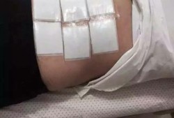 孕期腰扭伤（孕期腰扭伤）
