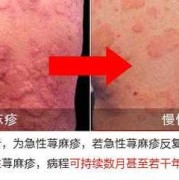 孕期寻麻疹图片（孕妇反复得荨麻疹要怎么治疗）