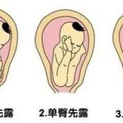 胎儿俯位（胎儿俯位）
