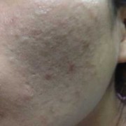 怀孕脸上长痘痘是什么原因,孕期脸上长粉刺是怎么回事