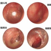 中耳炎会导致耳聋吗,孕妇中耳炎胎儿会聋吗怎么治疗