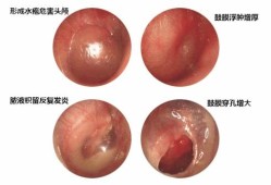 中耳炎会导致耳聋吗,孕妇中耳炎胎儿会聋吗怎么治疗