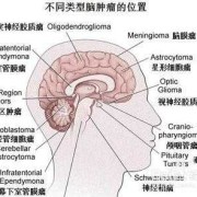 胎儿颅内肿瘤（胎儿颅内肿瘤）
