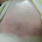 孕期皮肤变黑（怀孕后乳房变黑怎么回事）