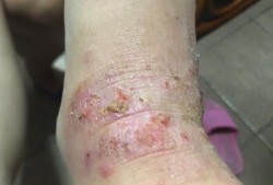 孕妇长湿疹是什么原因？是体质变弱的原因吗,孕期湿疹越来越严重怎么办
