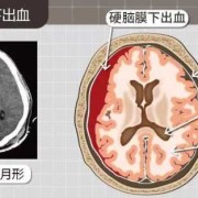 胎儿脑颅出血能要吗（胎儿脑出血还能要吗）