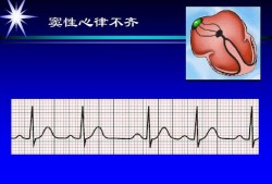 什么是窦性心律不齐,孕期窦性心律不齐是怎么回事