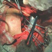 怀孕最早多少周可以剖腹产,剖腹产胎儿多少周可以剖腹产