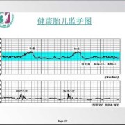 胎儿电子监护（EICU是什么意思）