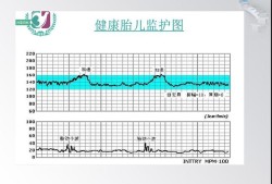 胎儿电子监护（EICU是什么意思）